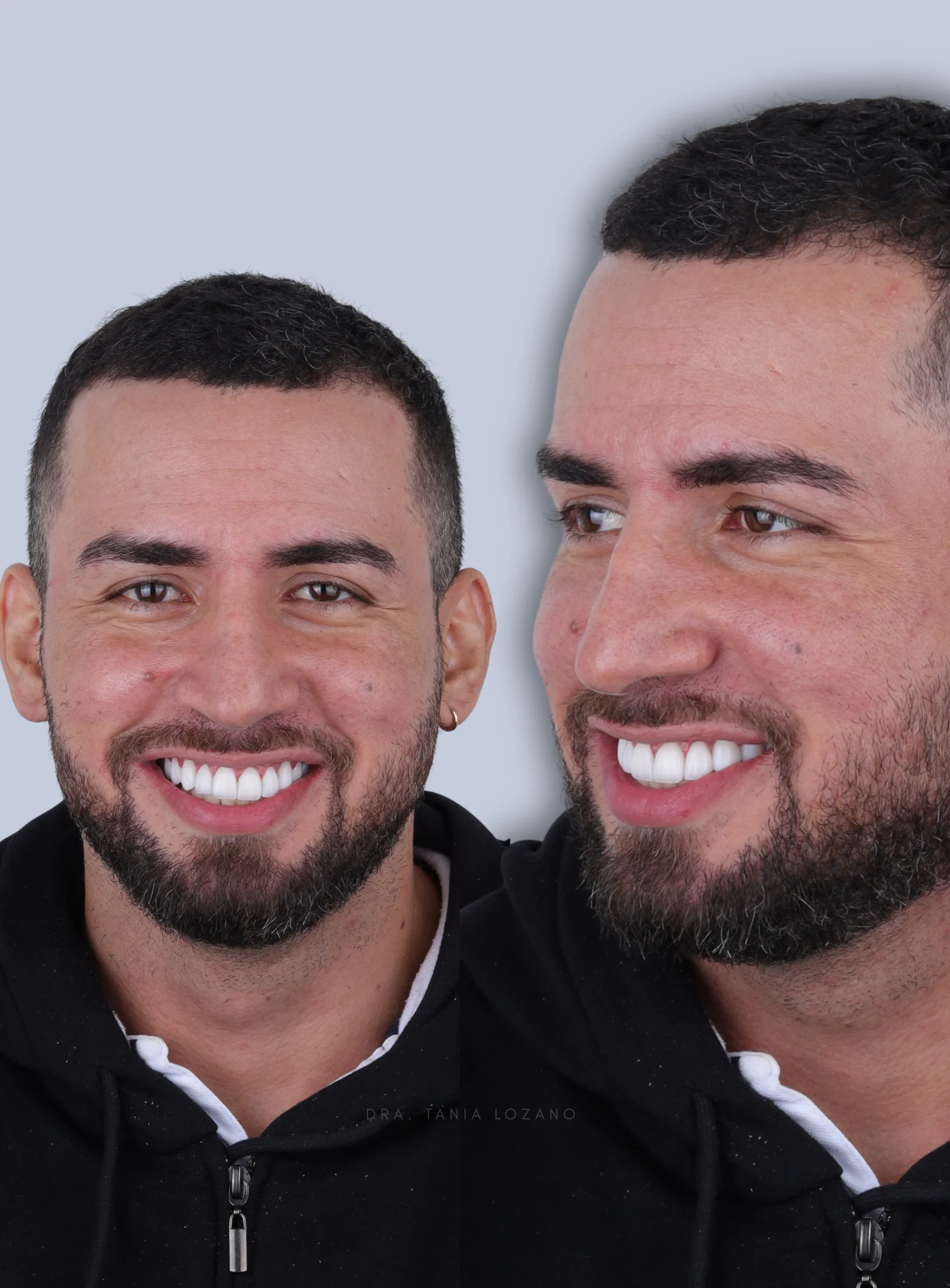 Sonrisa personalizada de una paciente OTL