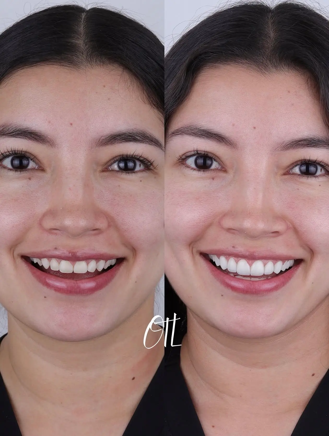 Antes y despu&eacute;s del caso real OTL 01