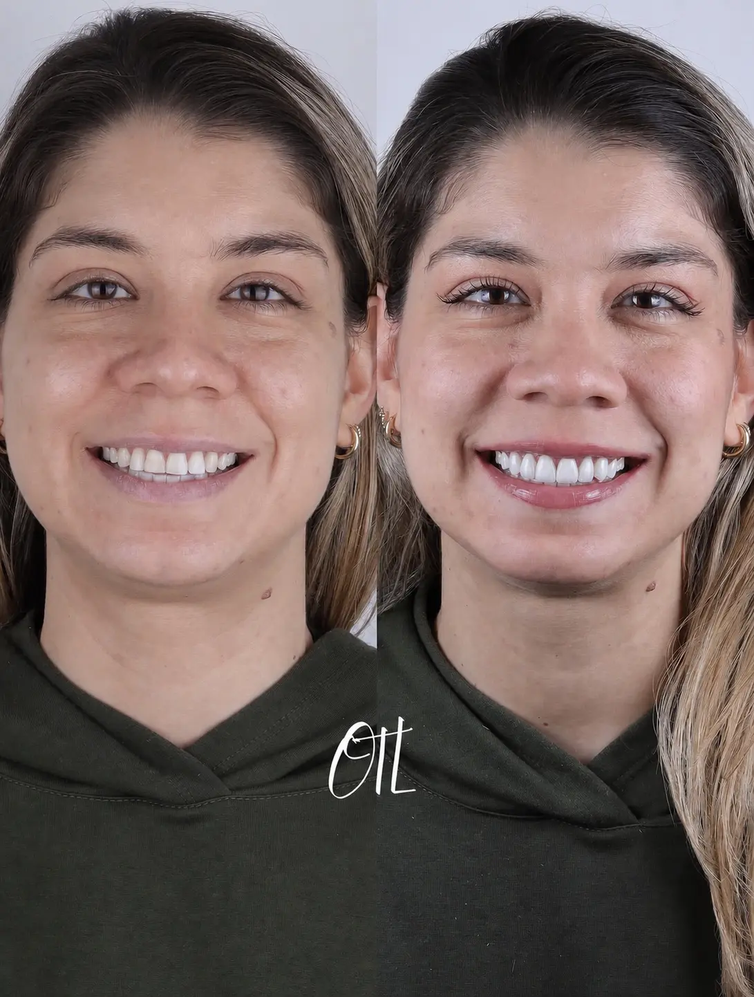 Antes y despu&eacute;s del caso real OTL 02