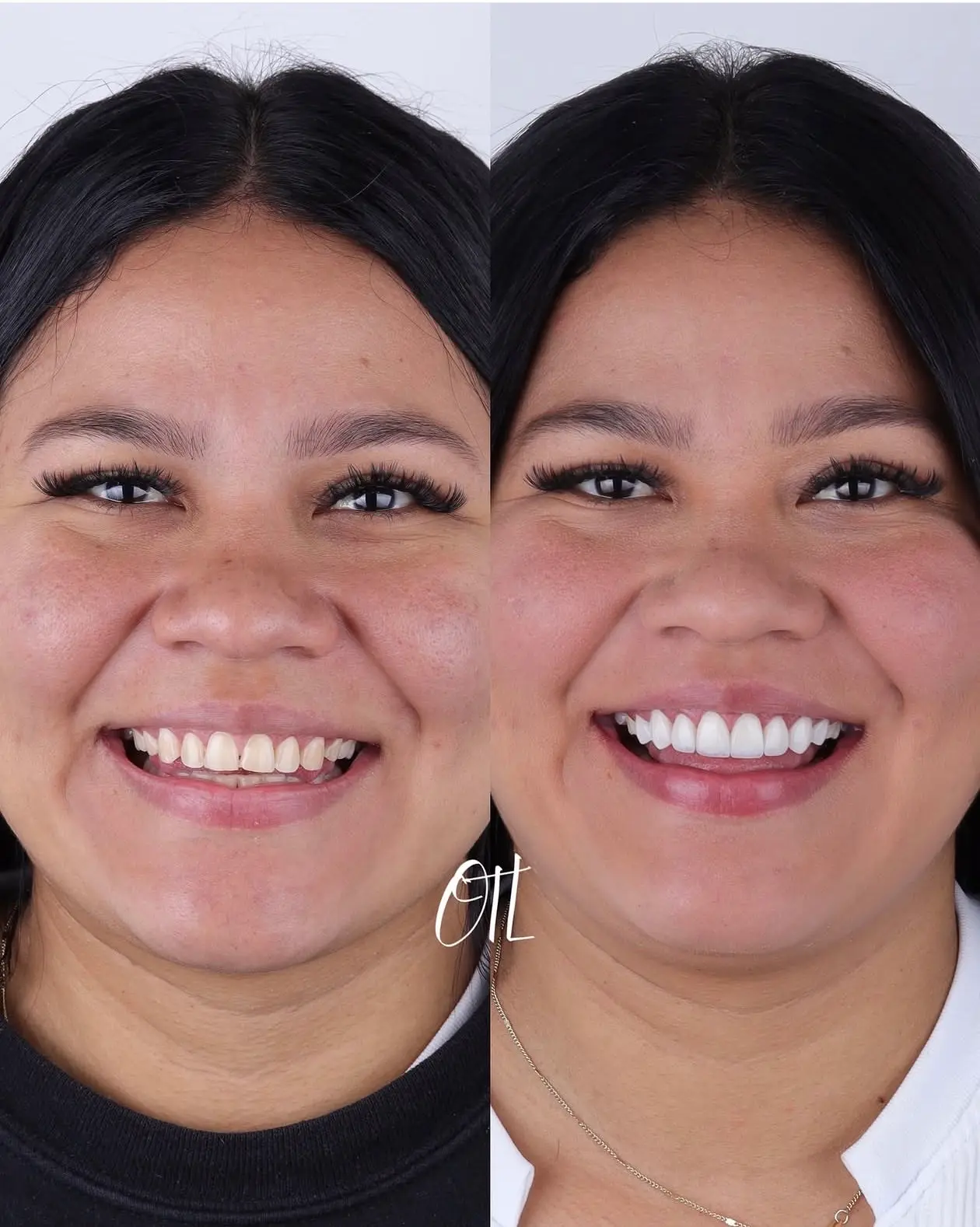 Antes y despu&eacute;s del caso real OTL 03