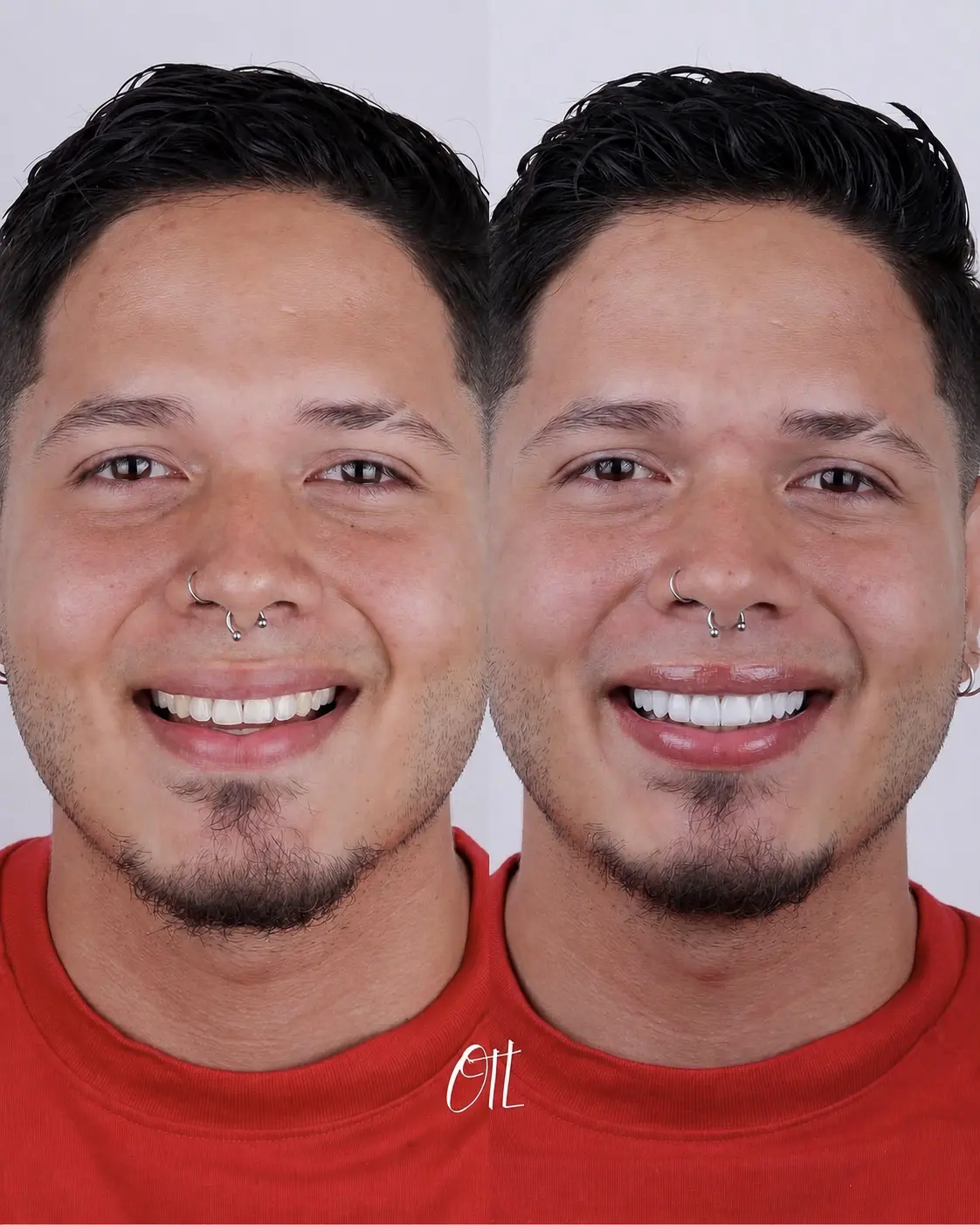 Antes y despu&eacute;s del caso real OTL 05