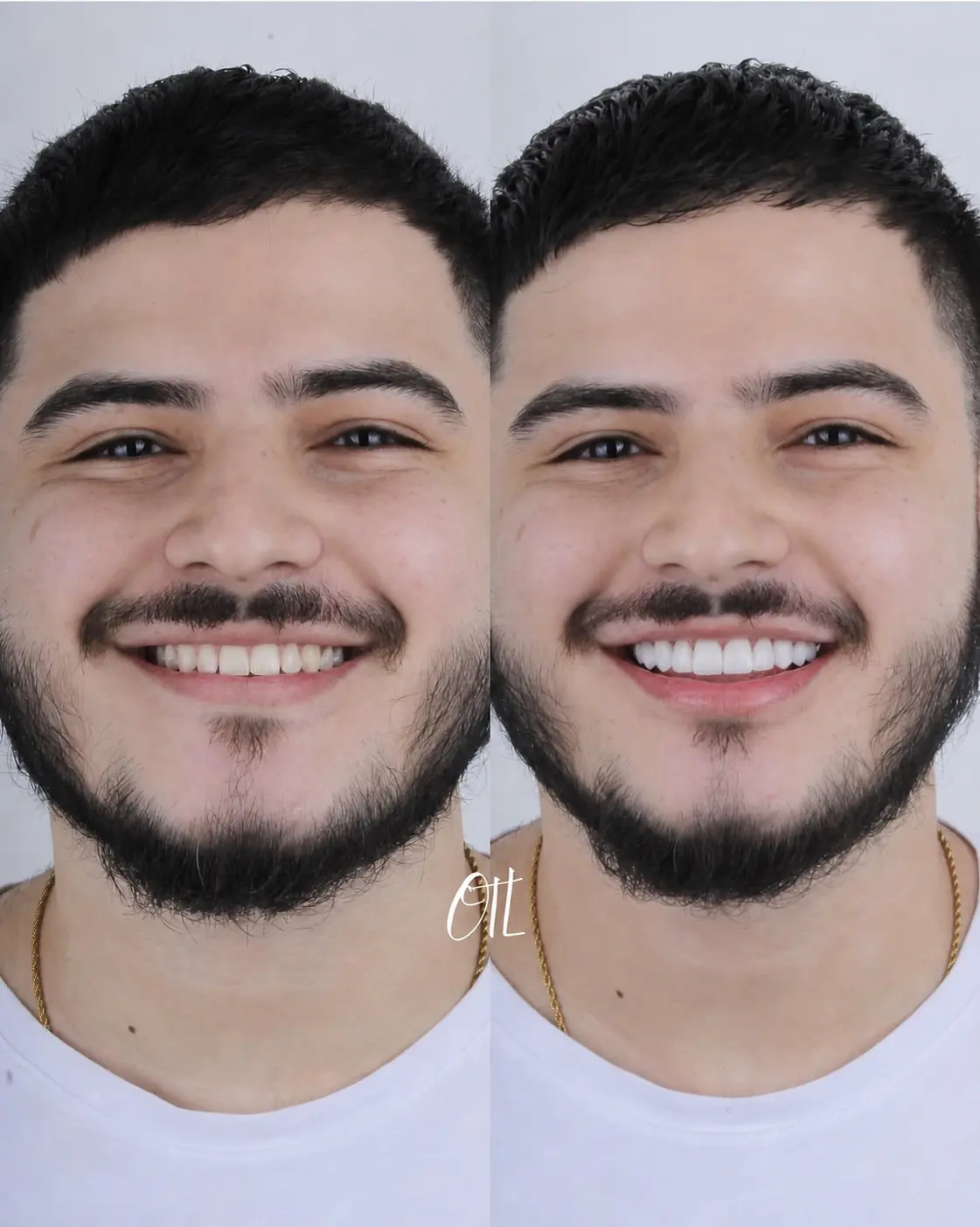 Antes y despu&eacute;s del caso real OTL 06