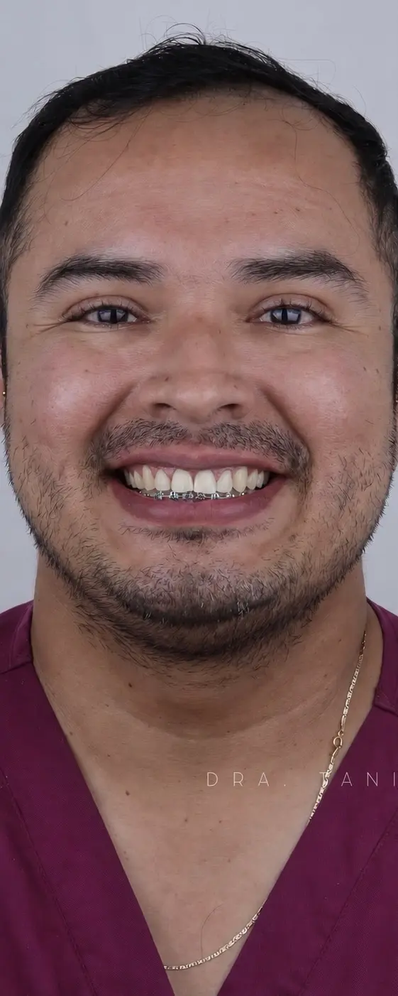 Sonrisa del paciente antes de su tratamiento OTL
