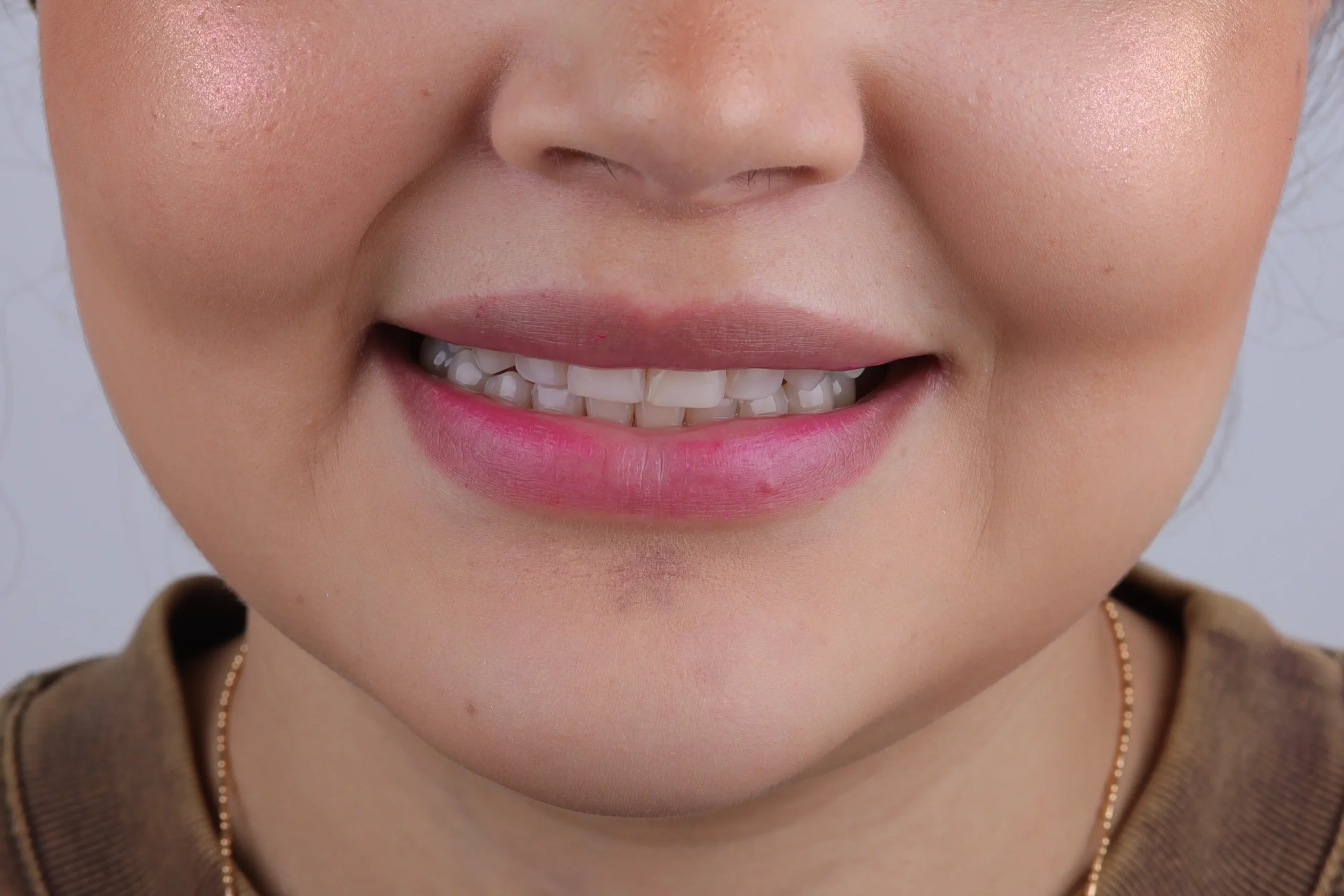 Sonrisa de la primera paciente antes de su tratamiento OTL