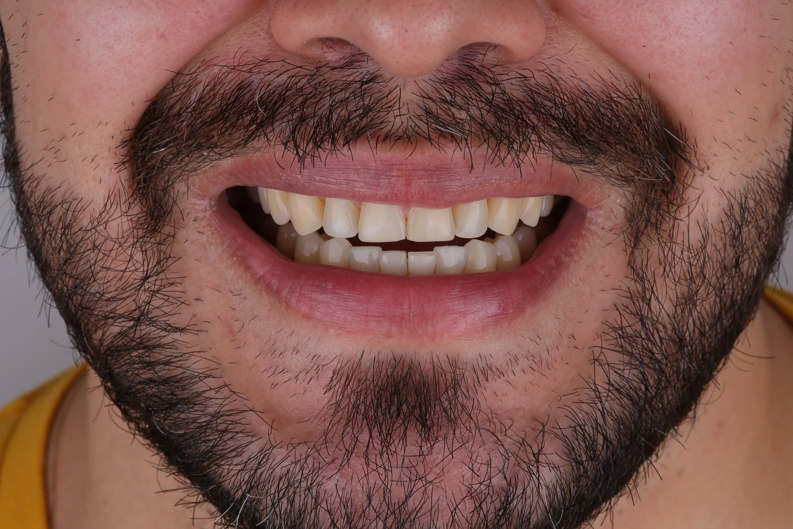 Sonrisa del segundo paciente antes de su tratamiento OTL
